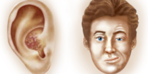 sindrome-de-Ramsay-Hunt