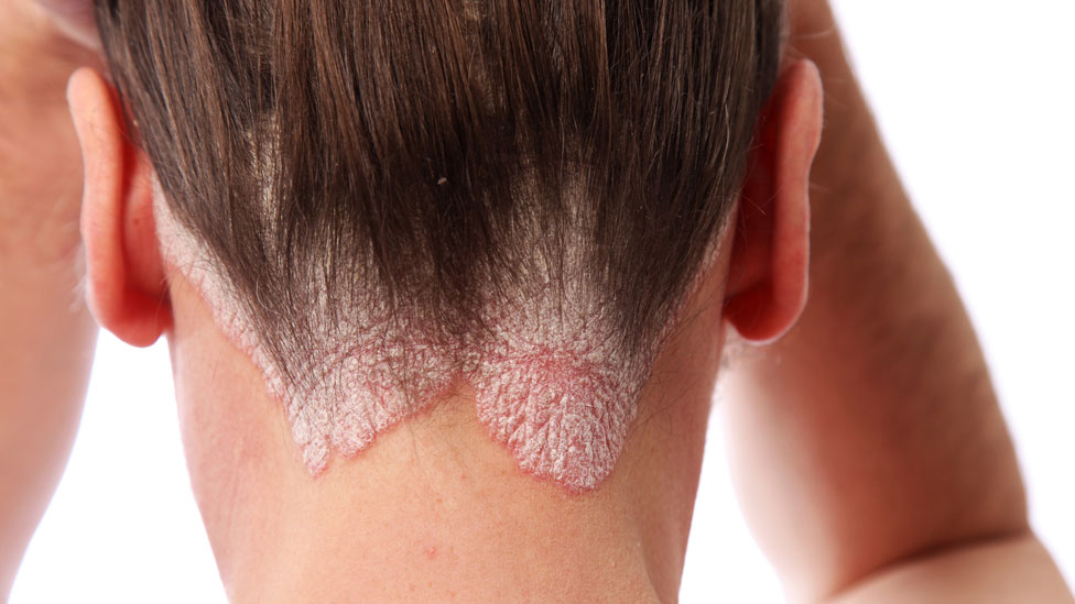 psoriasis-en-la-oreja