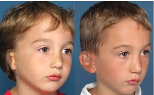 microtia